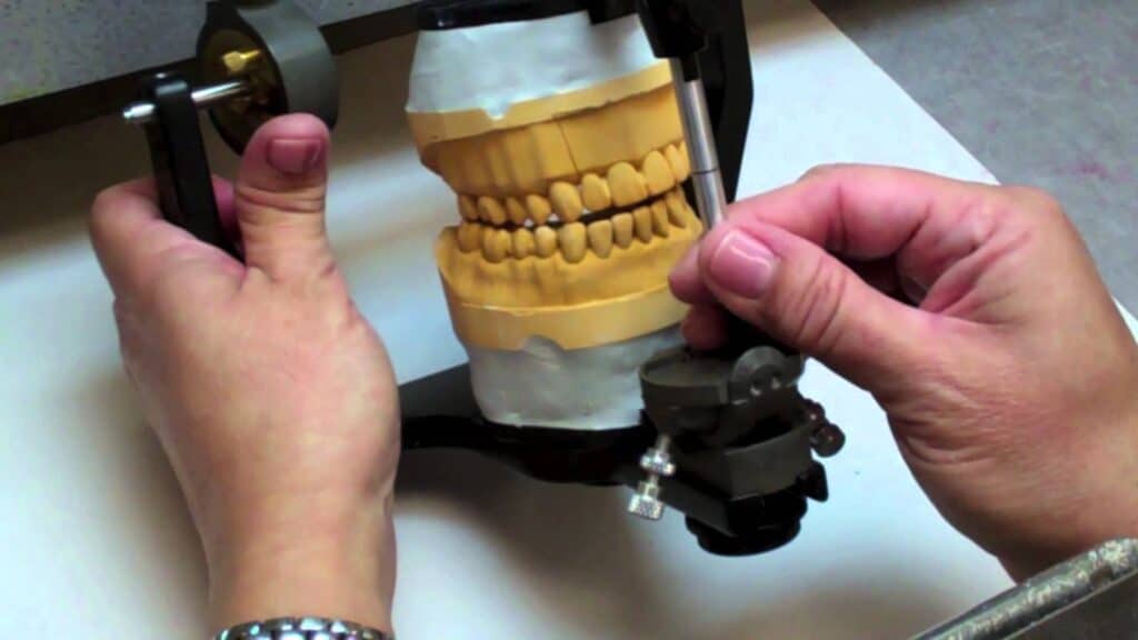 Occlusal Analysis of Orthodontic Treatment